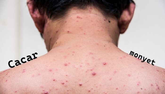 Terjawab Hasil Pemeriksaan Suspek Cacar Monyet di Tarakan Kaltara, Dinkes Waspada Dini